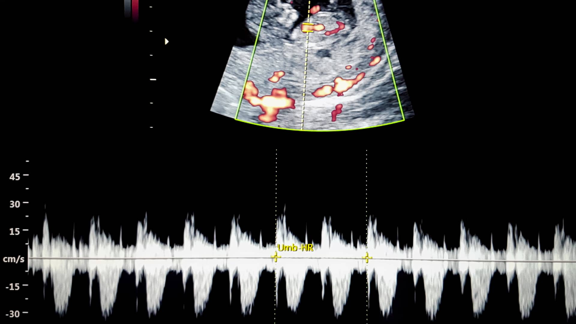 12 semanas de embarazo: primera ecografía en la sanidad pública