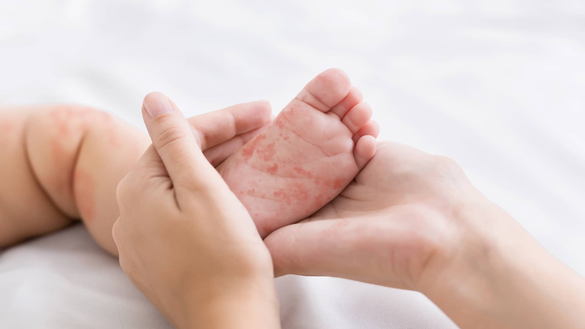 Alergias en niños: tipos más comunes, síntomas y tratamiento