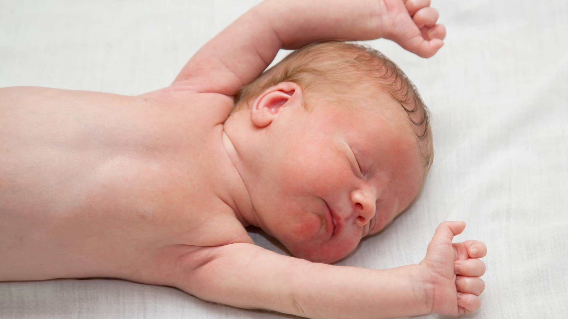 un bebe delgado sin masa muscular que padece hipotonia