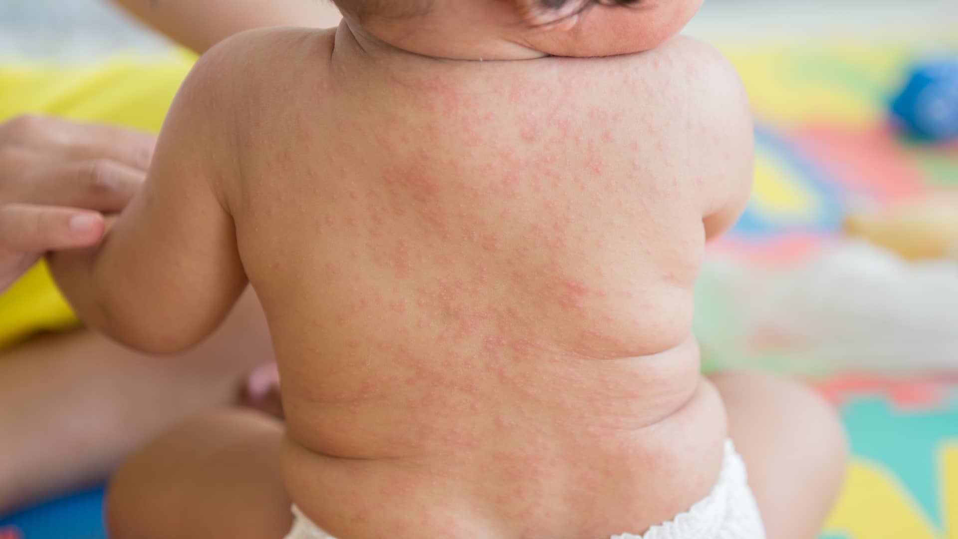 Manchas en la piel en los niños: las más comunes