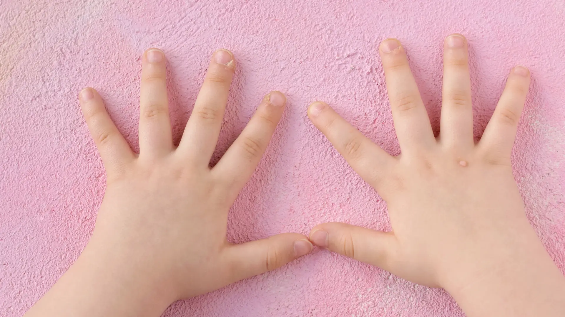 manos de un bebe que tiene berrigas en la parte superior de los dedos